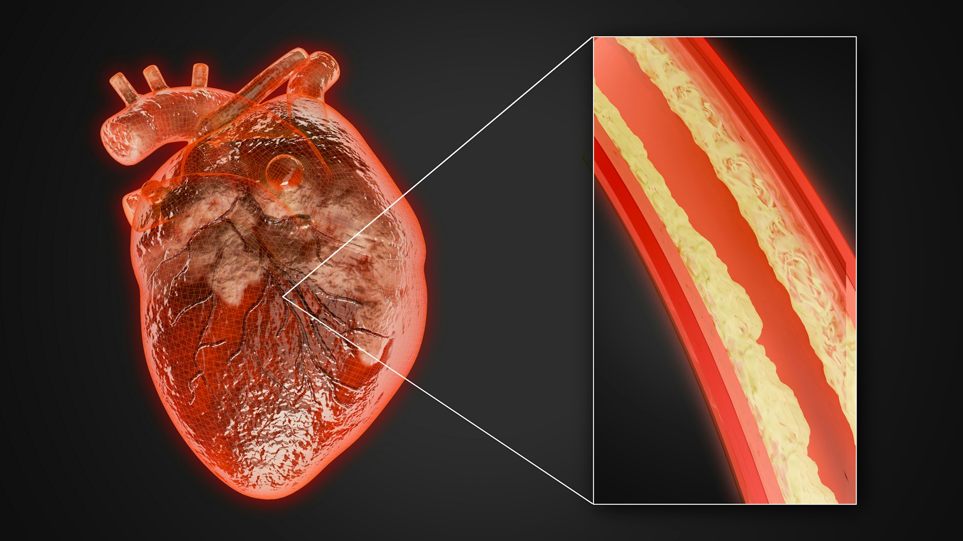 Atherosclerosis I: Reduction, Nattokinase, Digital Pulse Wave Analysis -  Townsend Letter